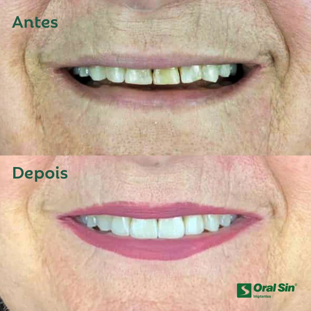 antes e depois cacho