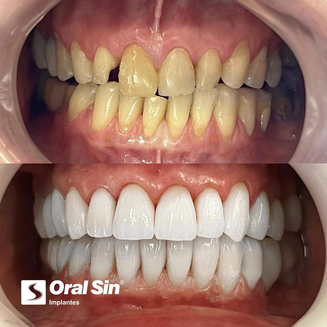 Antes-e-depois-facetas2