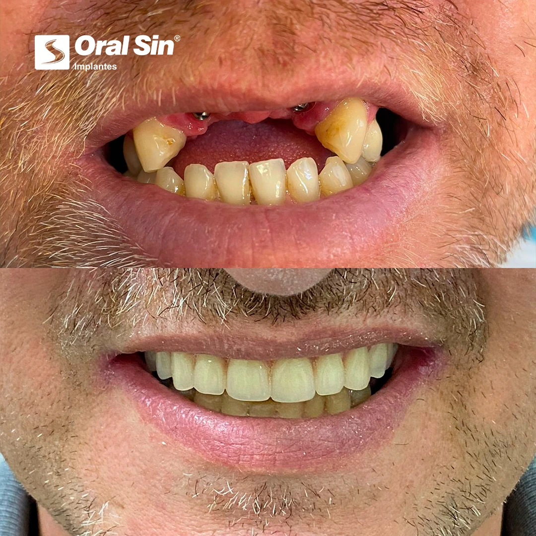 PACIENTE-1-ANTES-E-DEPOIS