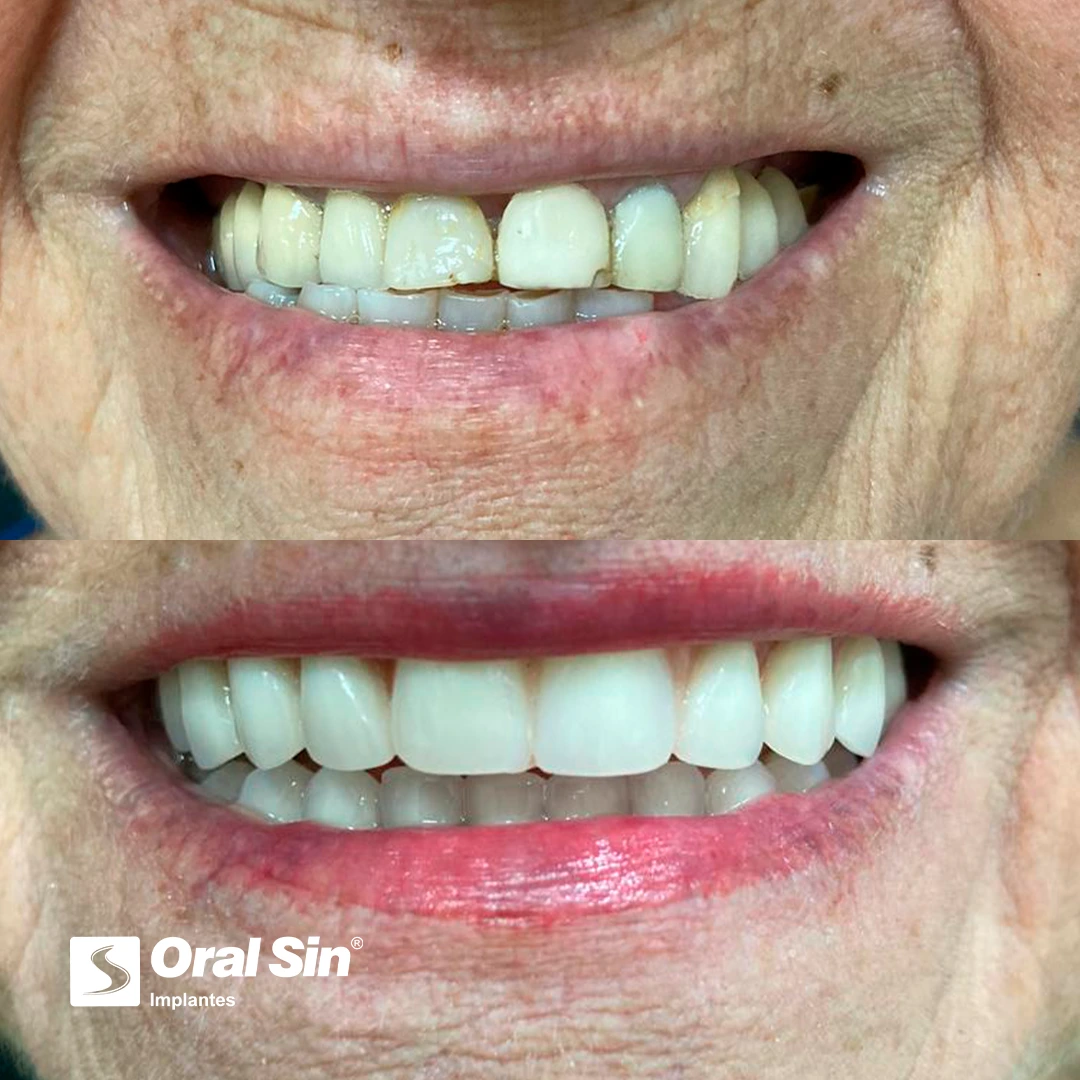 PACIENTE-3-ANTES-E-DEPOIS