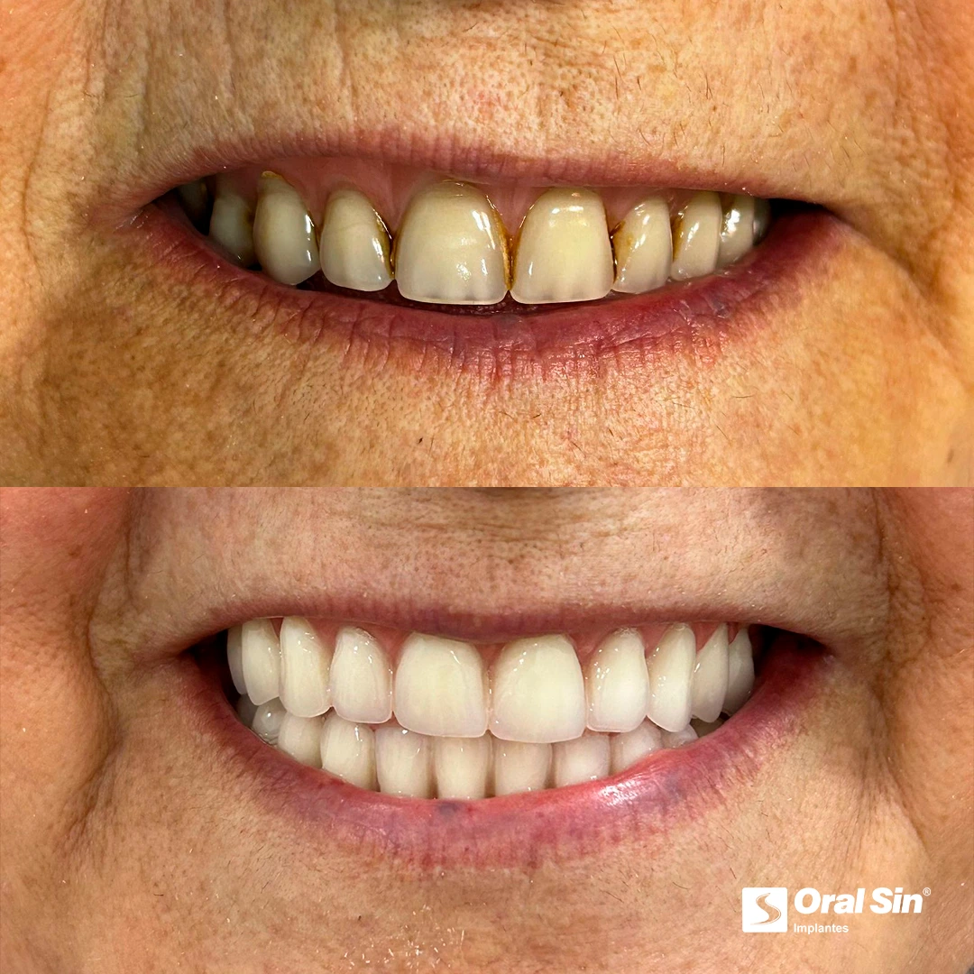 antes-e-depoisViamao-1