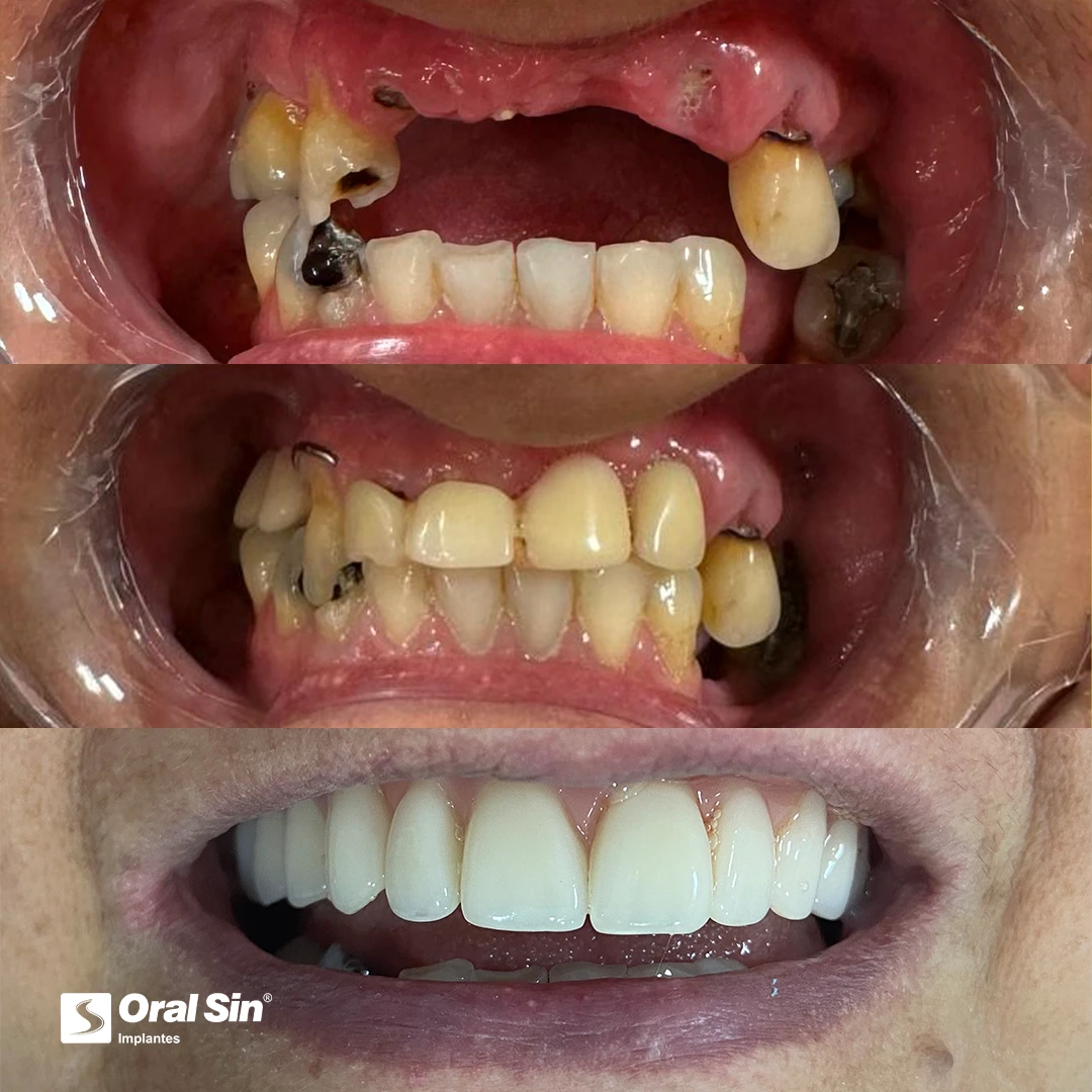 poa-sz-antes-e-depoispaciente-1